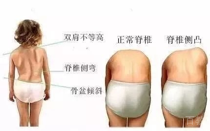 脊柱侧凸推拿治疗